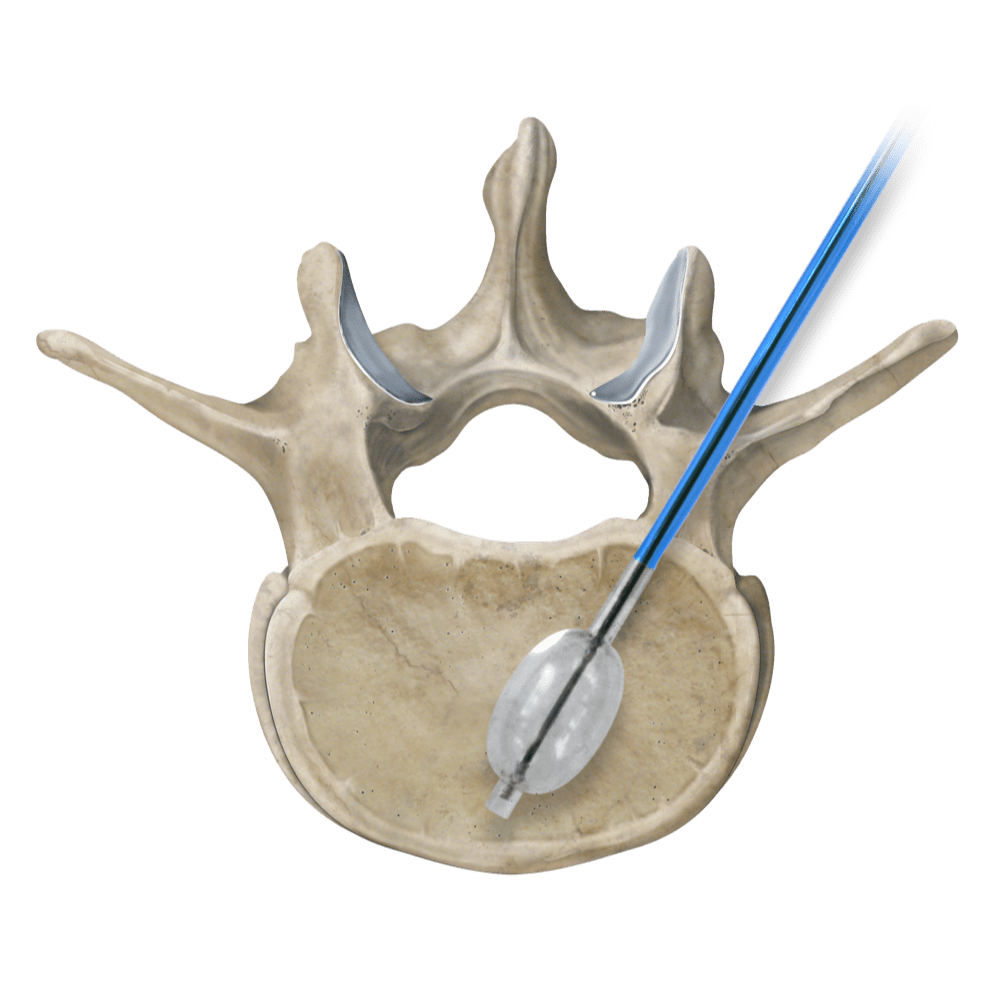 Osteo-Site Vertebral Balloon