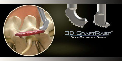 3D GraftRasp System