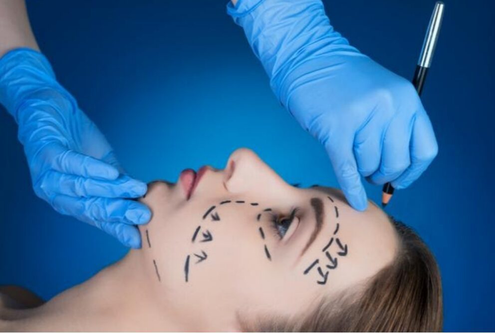 Facelift Surgery