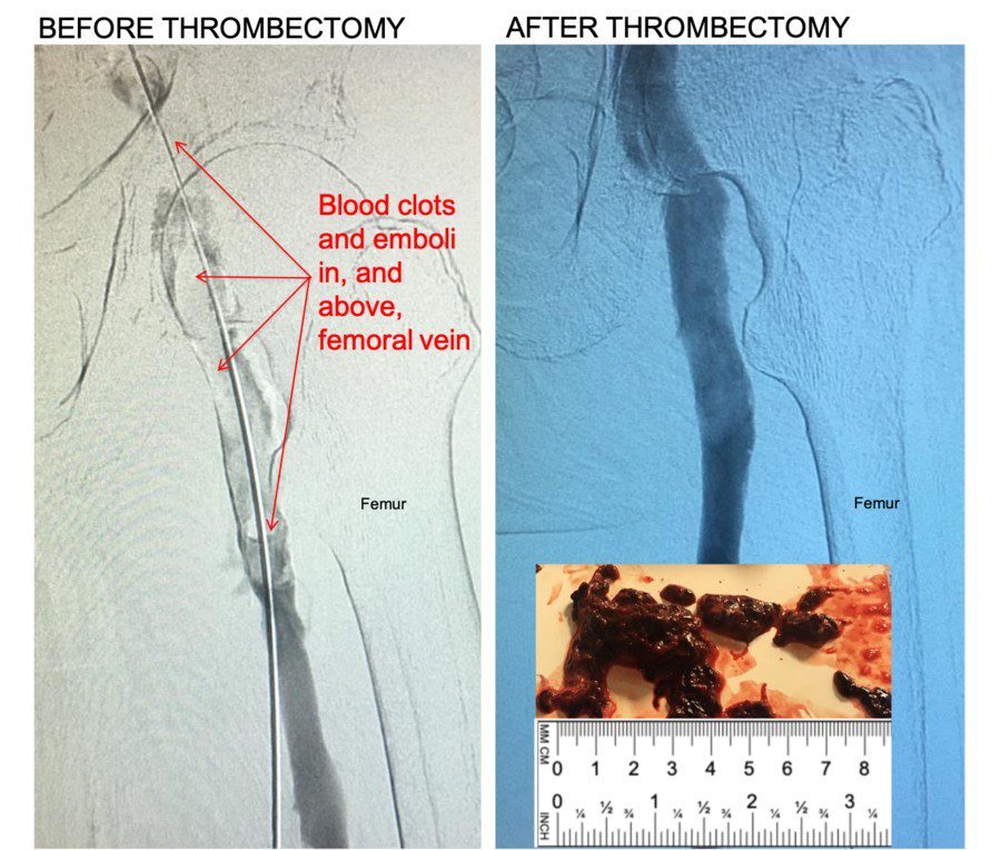 Control 11F Mechanical Thrombectomy System