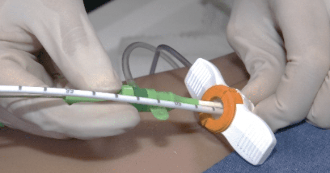 MEDCERT, Single Access Procedure with Impella CP