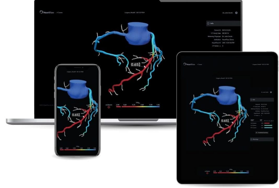 NICE, Renews Support for Use of AI-powered HeartFlow Analysis in Heart Disease Diagnosis