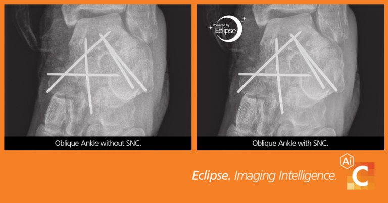 Carestream Health Advances X-ray Image Quality with Smart Noise Cancellation