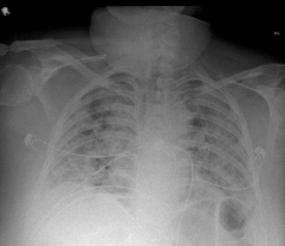 Chest x-ray, artificial intelligence tool