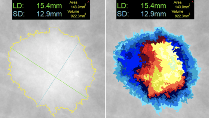 FDA Clears DL Precise One-Click Segmentation & Measurement Tool Delivers Consistent Precision in All Medical Imaging Modalities