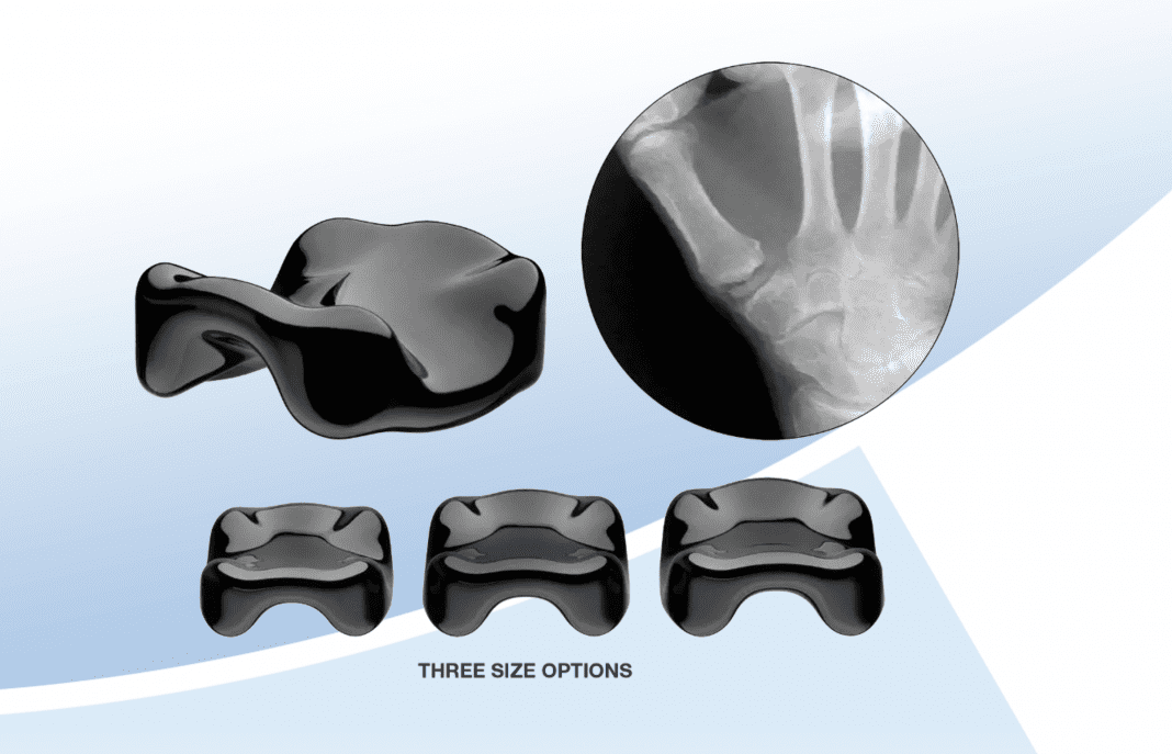 Ensemble Orthopedics Announces 35th Implantation Of Minimally Invasive CMC Device To Be Showcased At 2021 ASSH Meeting