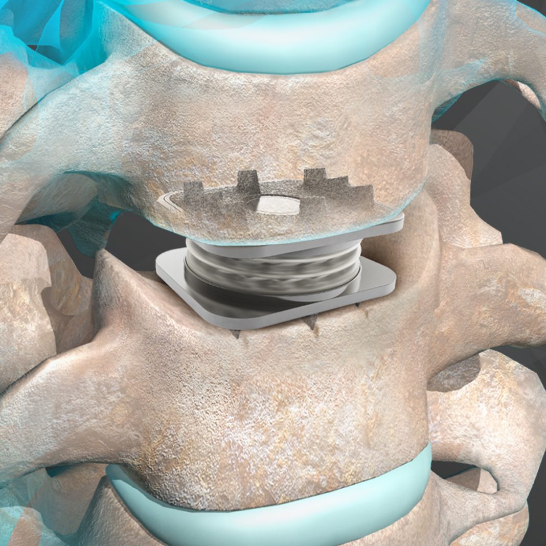 Orthofix Announces Milestone: More Than 60,000 M6-C Artificial Cervical Discs Implanted Worldwide