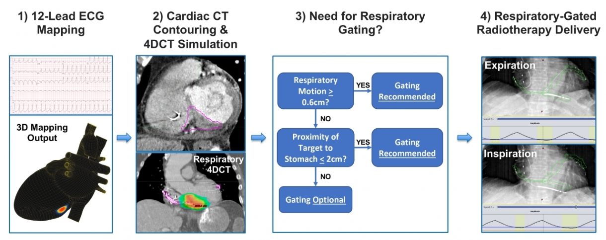 Vektor Medical's vMap™ Mapping System Reported as Feasible and Effective as Part of a Non-Invasive Workflow for Arrhythmia Management When Using Stereotactic Ablative Radiotherapy