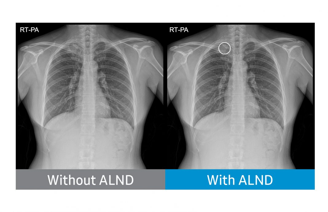 Neww Samsung Receives FDA Clearance for AI Algorithms that Detect Lung Nodules in Chest X-rays