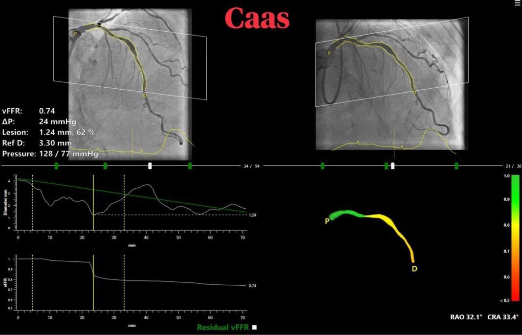 News Pie Medical Imaging Announces FASTIII, a Multicenter Randomized Clinical Trial