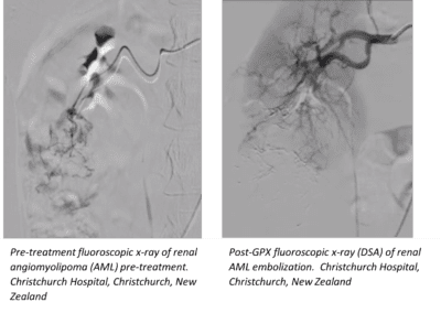 Renal Aml - Christchurch Image Set