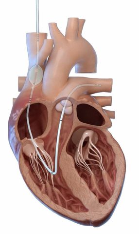 preCARDIA Technology