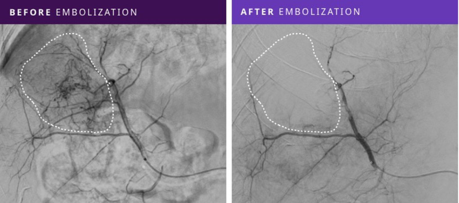 Instylla First-In-Human Clinical Trial Published Results