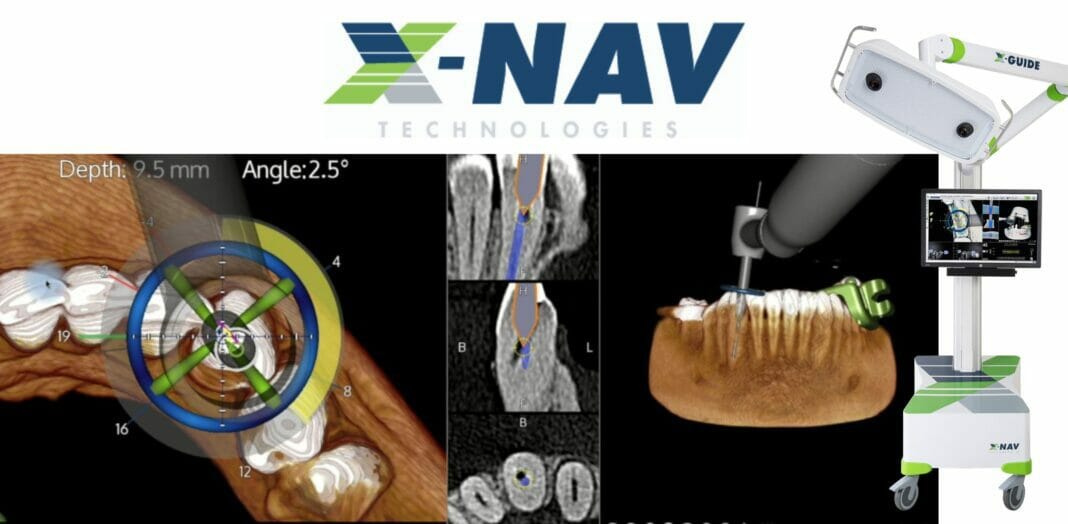 X-Nav Technologies Reports X-Guide Dynamic Navigation Receives FDA 510(k) Clearance To Aid in Minimally Invasive Endodontic Procedures