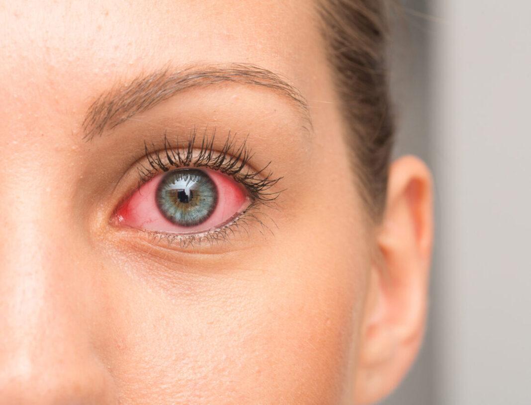 8 Common Causes Of Skin Irritation Around The Eyes: read this article to learn more.