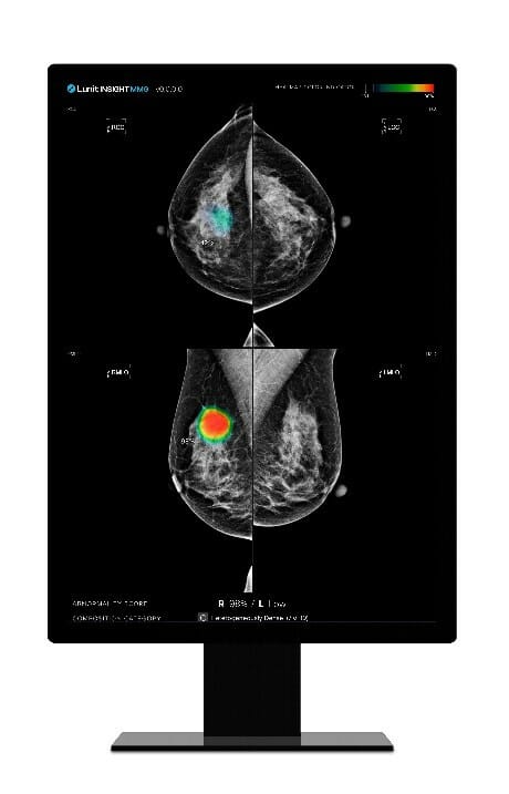 Lunit AI Solution for Breast Cancer Detection Wins Commercial Approval in Taiwan