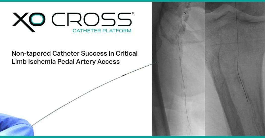 Tapered Catheter Success in Critical Limb Ischemia Pedal Artery Access