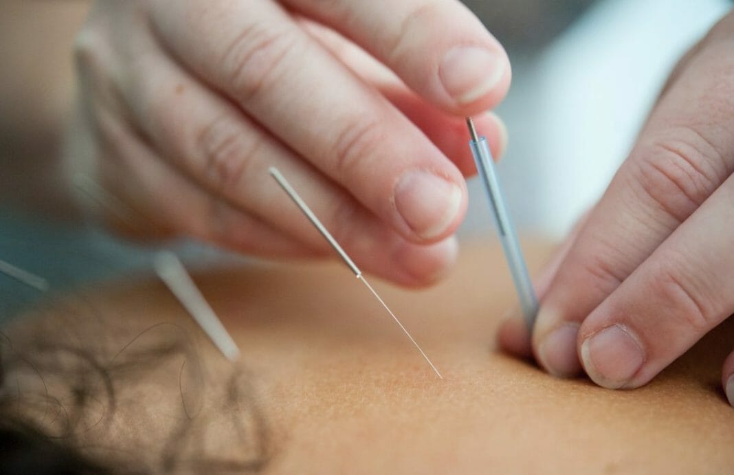 Questions to Ask your Acupuncturist