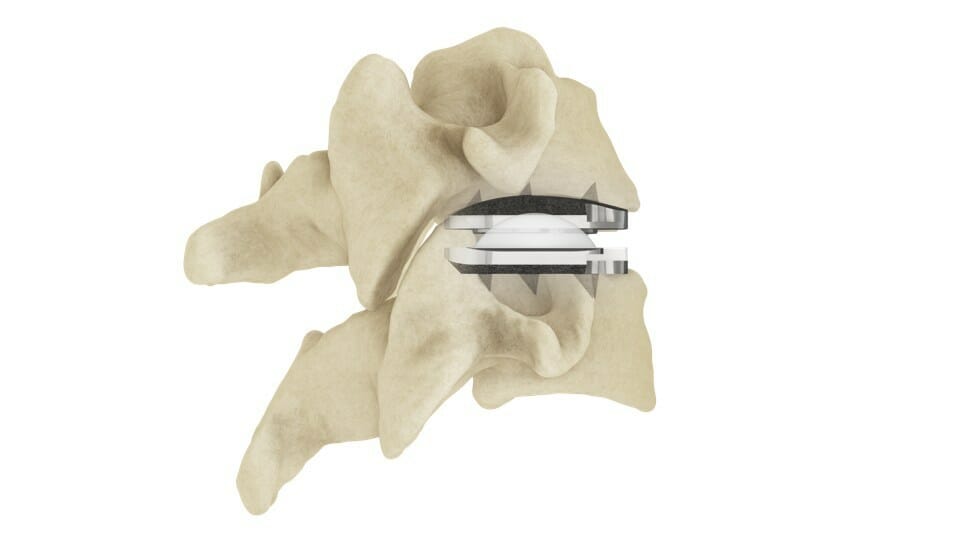 Centinel Spine Announces 100th Procedure with prodisc® C Vivo Cervical Total Disc Replacement Product