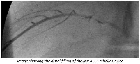 Fluidx Unveils New Embolic for Neurovascular Use