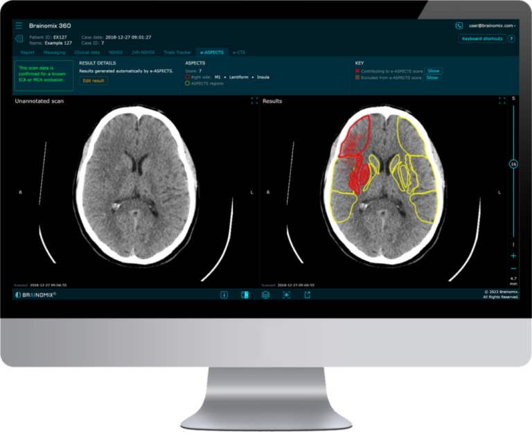 Brainomix Receives FDA Clearance for Its Flagship Stroke AI Imaging Software