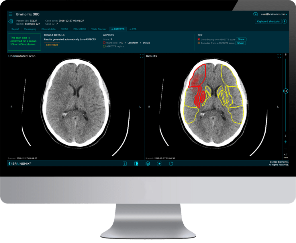 Brainomix