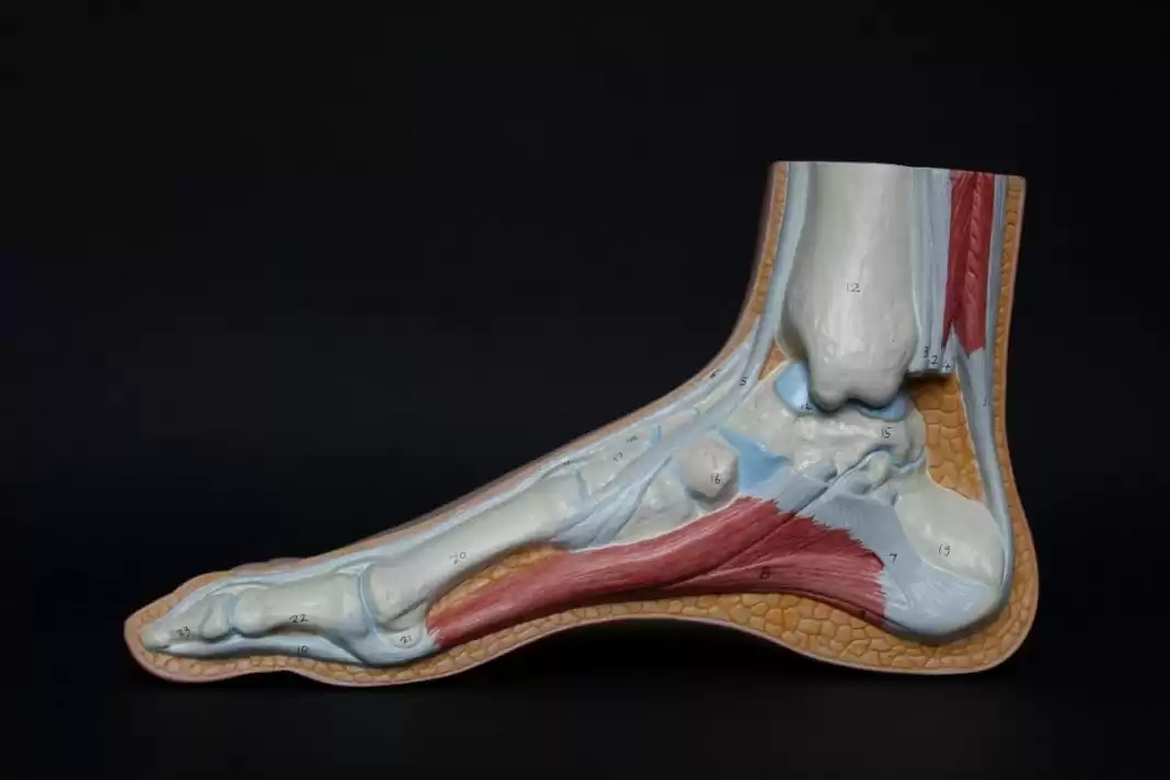 Plantar Fasciitis