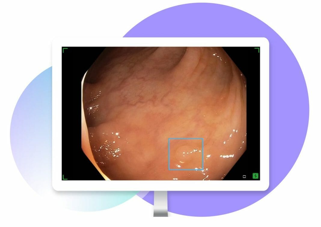 Polyp Detection