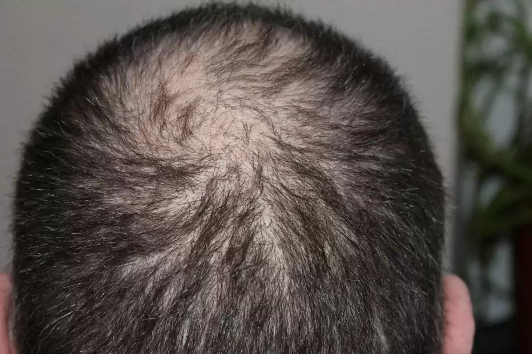 Male Hair Loss