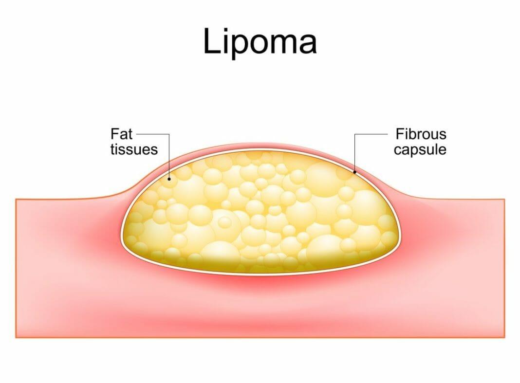 Lipoma Removal