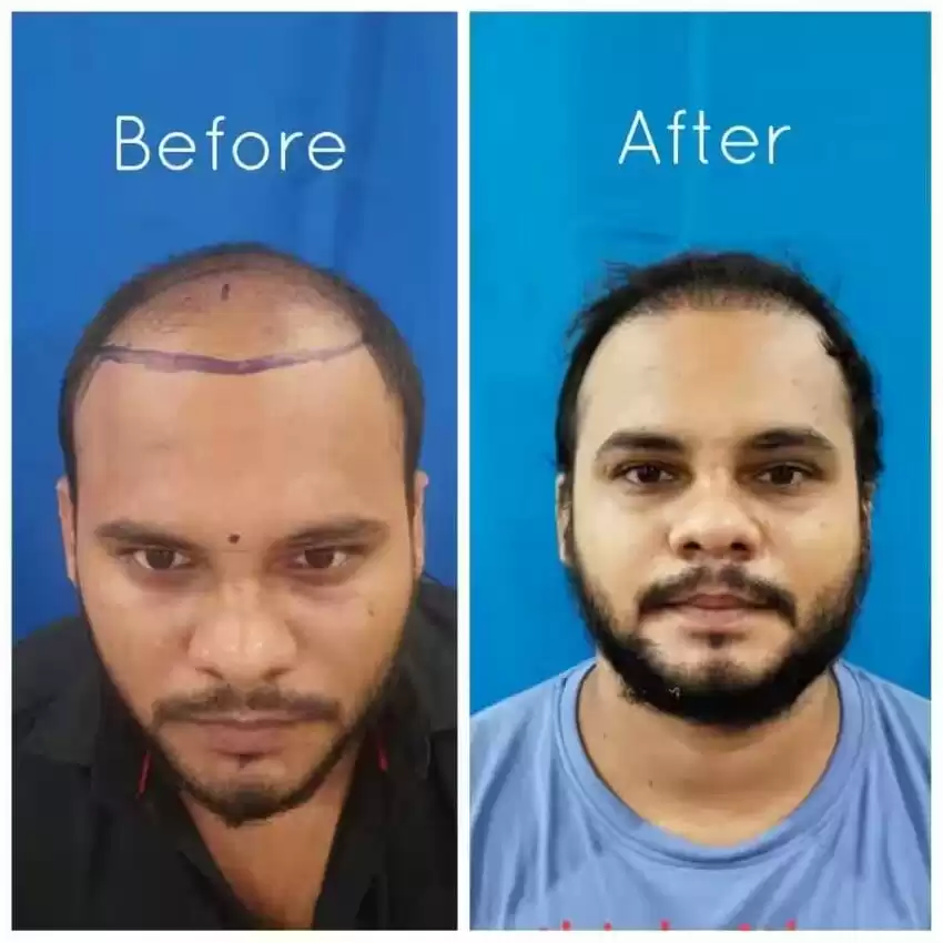 Hair Loss