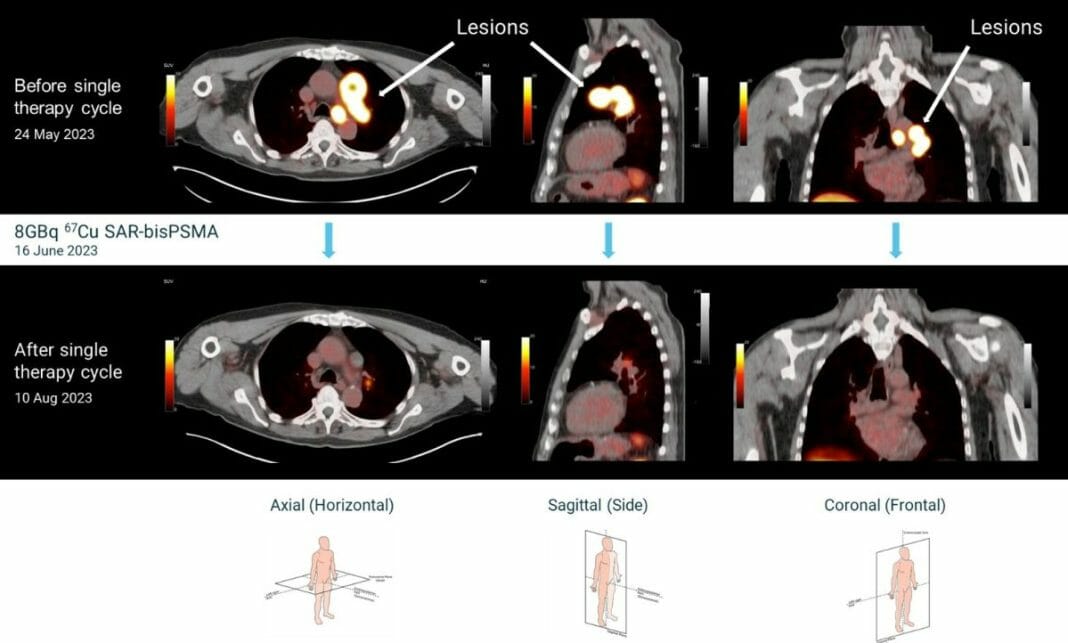 Prostate Cancer Trial