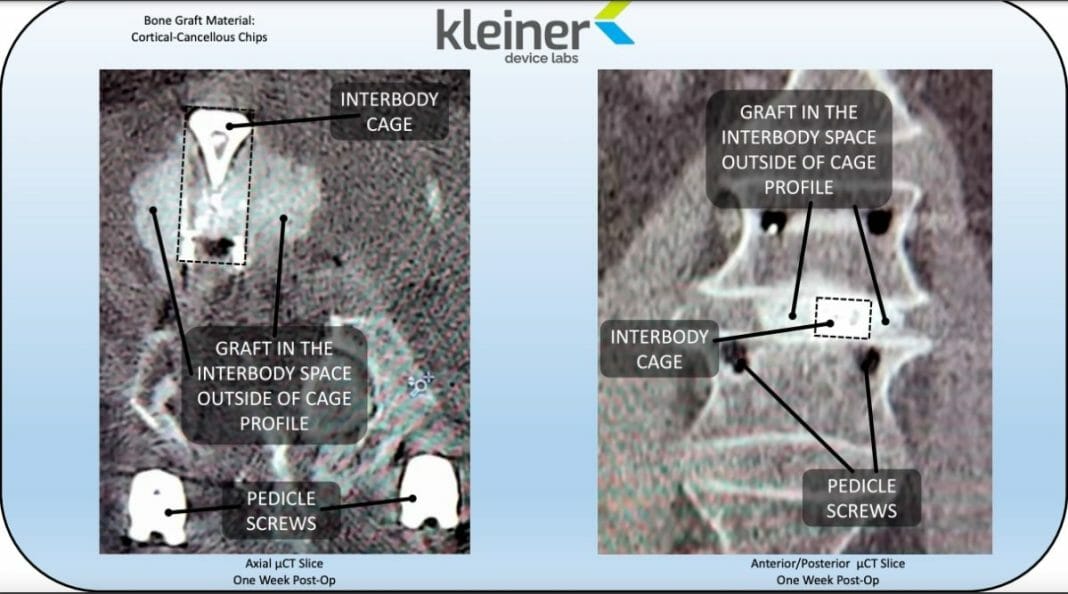 KG2 Surge Flow-Thru Interbody System