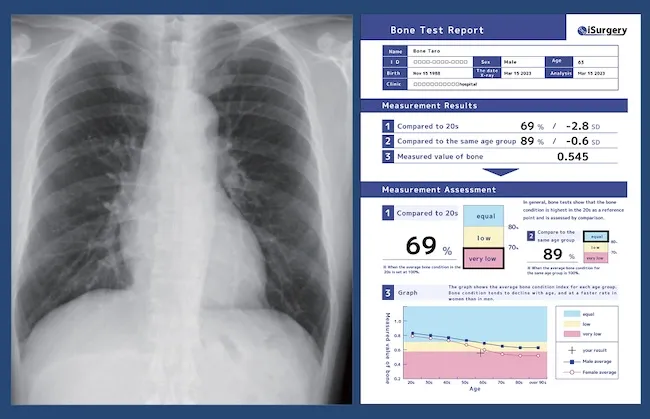 Bone Health