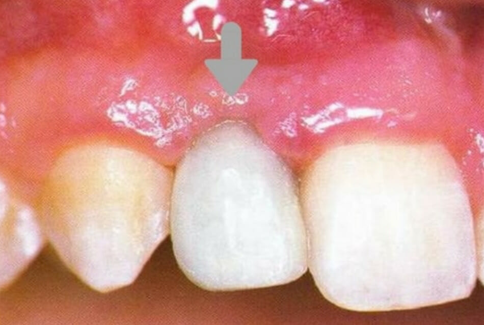 Dental Cement in Orthodontics