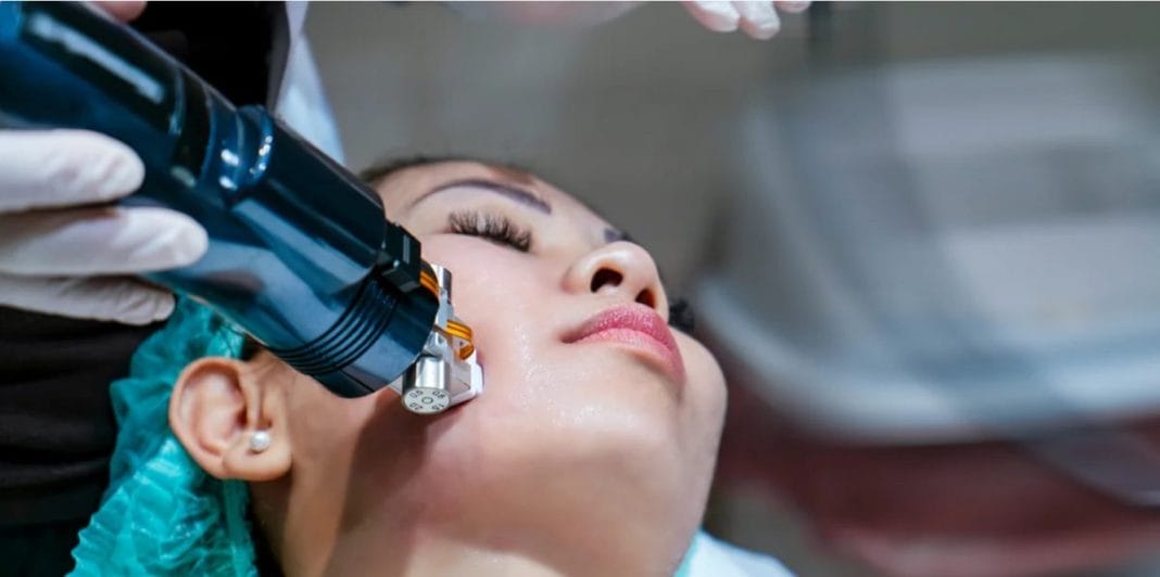 Radio Frequency Microneedling