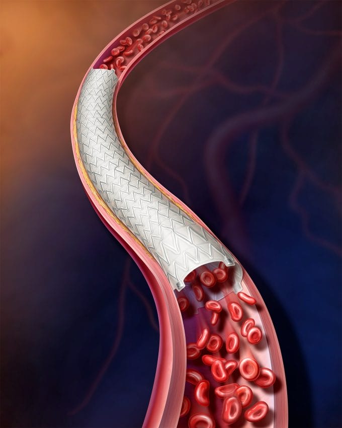 Peripheral Arterial Disease