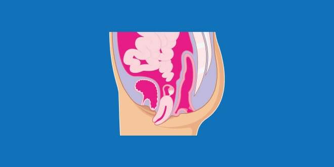 Pelvic organ prolapse