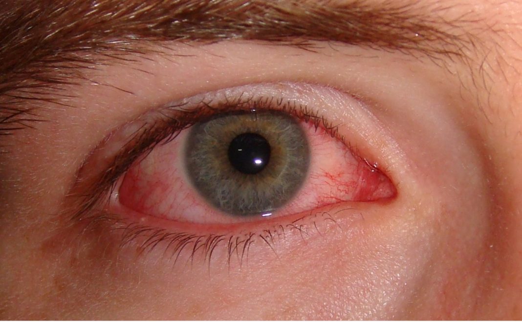 Pterygium